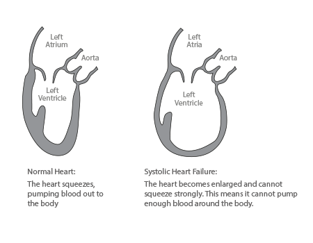 What causes heart failure?