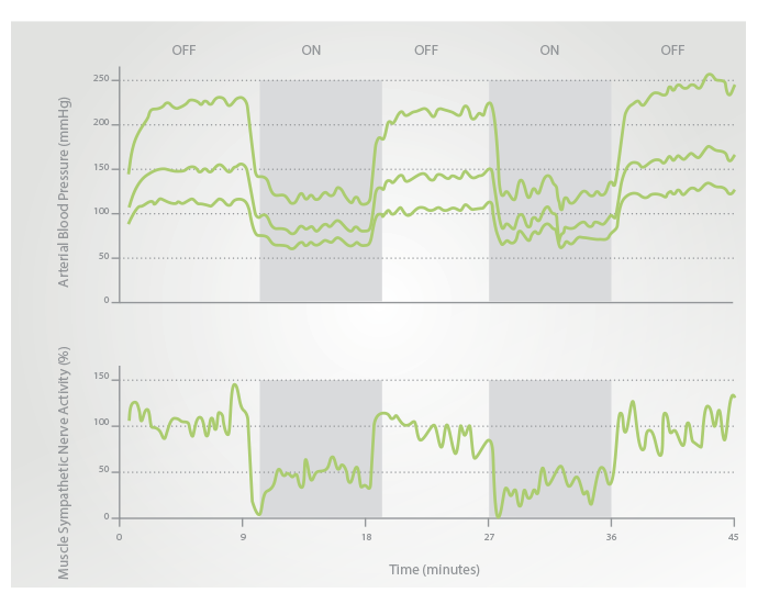 MSNA after chronic therapy in a 68-year old female